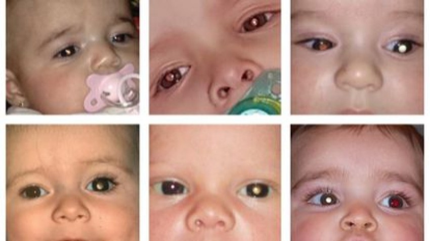 Foto principal de Retinoblastoma en niños: “Aunque yo en su día pensé que sí, la vida no se acaba tras el diagnóstico”